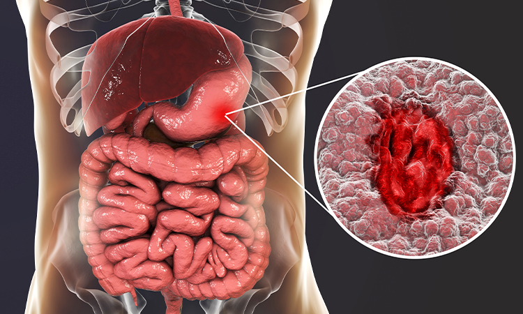 Stomach Ulcer (Gastric Ulcer): Symptoms, Causes, Diagnosis, Treatment, and Prevention