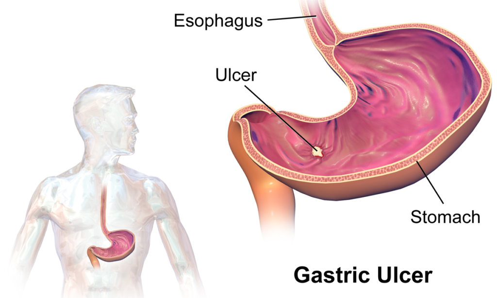 Signs and Symptoms of a Stomach Ulcer