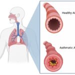 Asthma: Causes, Symptoms, Diagnosis & Treatment (2025 Guide)