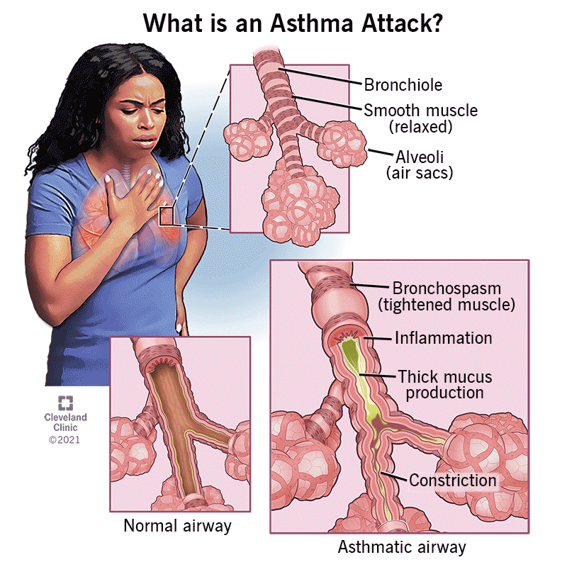 Symptoms and Causes of Asthma