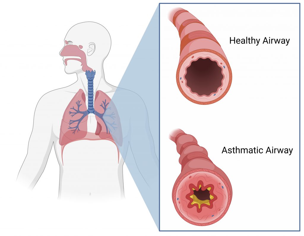 Asthma: Causes, Symptoms, Diagnosis & Treatment (2025 Guide)