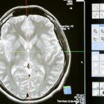 Epilepsy: Causes, Symptoms, Diagnosis & Complete Treatment